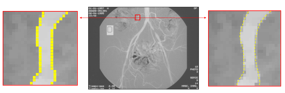 A medical X-ray angiogram of blood vessels in the center, with two zoomed crops on either side showing yellow contour lines traced precisely along a vessel boundary.