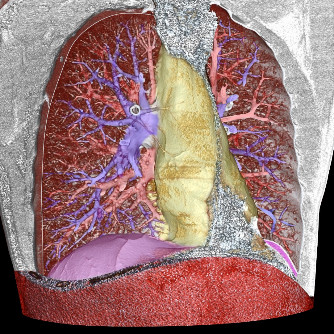 A 3D CT reconstruction of a human thorax with bone and tissue rendered in distinct regions